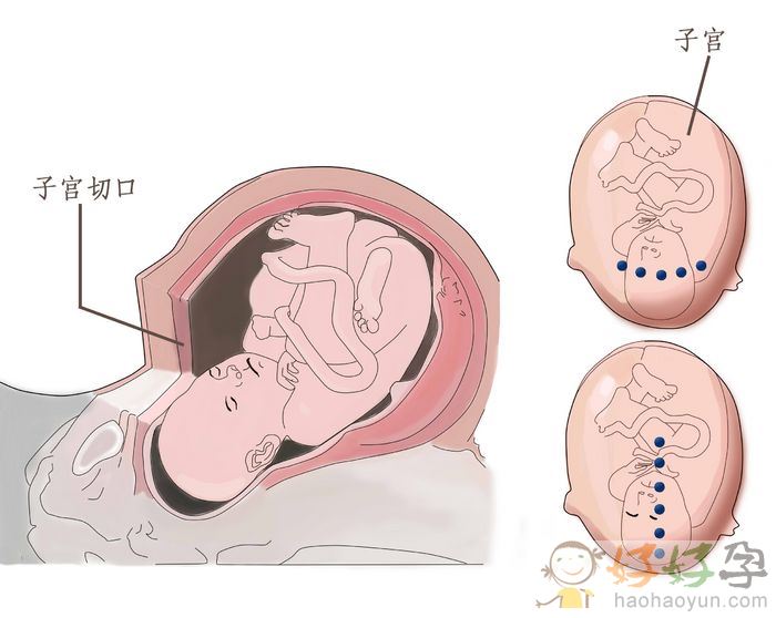 剖腹产分娩必知整个剖腹产手术全过程图片