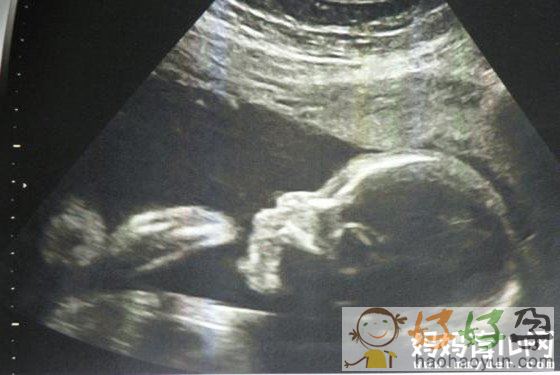 怀孕八个月男胎儿图怎么看 如此辨认男女so easy!