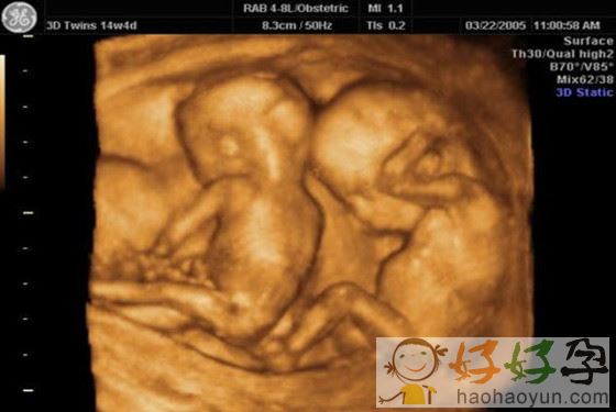 一胎怀俩 怀孕双胞胎三个月肚子有多大(胎儿图片)